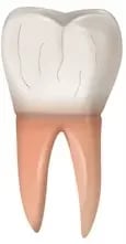 Craze Lines - dental crack type showing mild damage