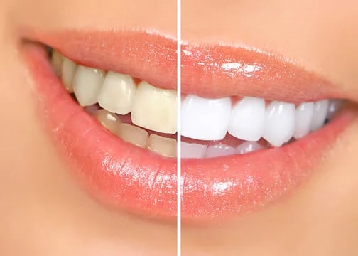 Before and after internal bleaching showing tooth color restoration