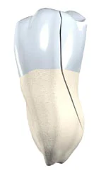 Split Tooth - dental crack type showing severe damage
